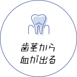 歯茎から血が出る 歯周病治療
